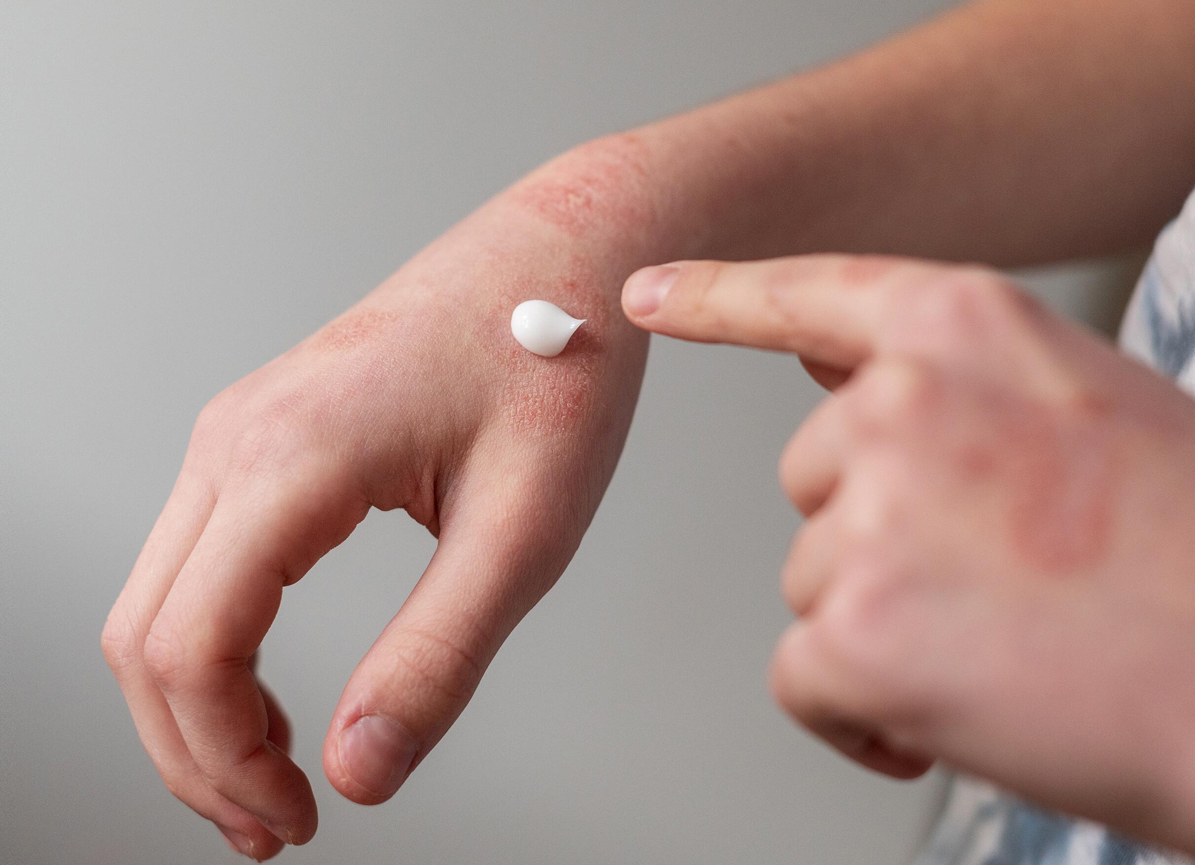 médicament bouton eczéma